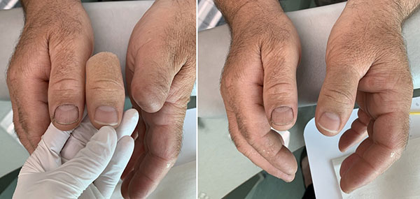 tg5 6h56h قیمت پروتز انگشت دست چقدر است؟ معرفی انواع ساخت پروتز انگشت دست